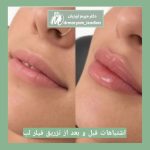 اشتباهات رایج بعد از تزریق فیلر