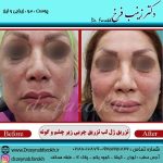 فتگرفت دور چشم: راه حلی طبیعی برای رفع تیرگی و چین و چروک با تزریق چربی