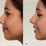 بهترین مارک های فیلر بینی برای رفع نواقص و عدم تقارن بعد از جراحی بینی