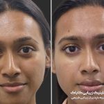 رفع خط خنده با فیلر یا بوتاکس؟ مشاوره تخصصی دکتر سوسن احمدی