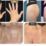 زوند جذب فیلر در بدن چگونه است