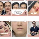 تغییر عالی چهره با تزریق چربی طبیعی در تهران: جدیدترین متدها با دکتر سوسن احمدی
