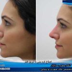 متخصص تزریق فیلر بینی در تهران برای رفع نواقص بینی بعد از عمل