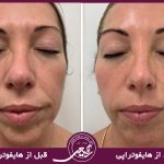 جوانسازی پوست صورت با هایفو: روشی موثر برای رفع چین و چروک توسط دکتر سوسن احمدی