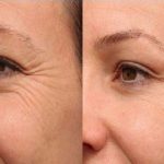 بوتاکس چطور جلوی چین و چروک را میگیرد؟