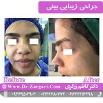 آیا مدیکال راینوپلاستی برای شما مناسب است؟ مشاوره با دکتر سوسن احمدی