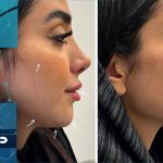 فیلد گونه: فقط برای حجم دهی نیست!