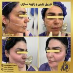 فیلم عمل مادلینگ صورت با تزریق چربی دکتر سوسن احمدی: مشاهده نتایج قبل و بعد