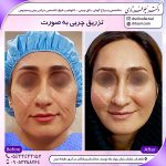 تزریق چربی نچرال با دکتر سوسن احمدی: ماندگاری بالا و نتایج طبیعی برای جوانسازی صورت