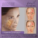 تزریق چربی به صورت برای مادلینگ: تکنیک های جدید و ماندگاری بیشتر با دکتر احمدی
