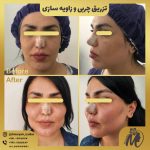 مادلینگ صورت طبیعی با تزریق چربی: نمونه کارهای دکتر سوسن احمدی و نتایج شگفت انگیز