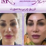 فتگرفت در کلینیک تخصصی: انتخاب جراح ماهر برای جوانسازی طبیعی با تزریق چربی