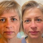 تفاوت فیلرهای موقتی و دائمی