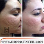 اثر نیدلینگ در کلاژن سازی پوست