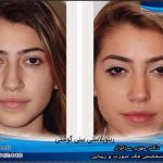 مدیکال راینوپلاستی برای بینی های گوشتی: آیا امکان پذیر است؟