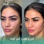 مقایسه چهره قبل و بعد از فیلر گونه