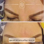 قبل و بعد از بوتاکس خم اخم