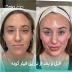 چهره های طبیعی بعد از تزریق بدون اغرق