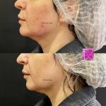 فیلم فرمدهی چانه با فیلر: مشاهده مراحل تزریق و نتایج قبل و بعد از عمل به صورت تصویری