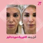 مادلینگ صورت با فیلر در تهران: مشاوره تخصصی دکتر سوسن احمدی برای داشتن چهره ای جذاب و متناسب