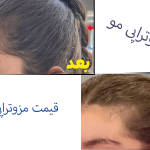هزینه مزوتراپی مو با دکتر احمدی: بررسی قیمت و عوامل موثر بر هزینه درمان ریزش مو با مزوتراپی
