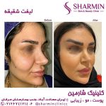 لیفت شقیقه بدون جراحی با دکتر سوسن احمدی: راهی نوین برای رفع افتادگی پلک و جوانسازی گیجگاه