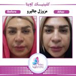 هزینه مزوتراپی ابرو در کلینیک دکتر سوسن احمدی: بررسی قیمت و عوامل موثر بر آن