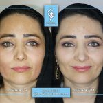 ماندگاری لیفت صورت با هایفو چقدر است؟ مشاوره تخصصی با دکتر سوسن احمدی