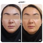 عوارض لیفت صورت با هایفو چیست؟ راهنمای کامل قبل از اقدام از دکتر سوسن احمدی بپرسید