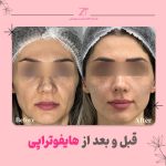 هزینه لیفت صورت با هایفو در مطب دکتر سوسن احمدی: قیمت مناسب و نتایج ماندگار
