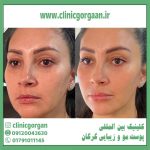 آیا فیلرها باعث افتادگی پوست میشود؟